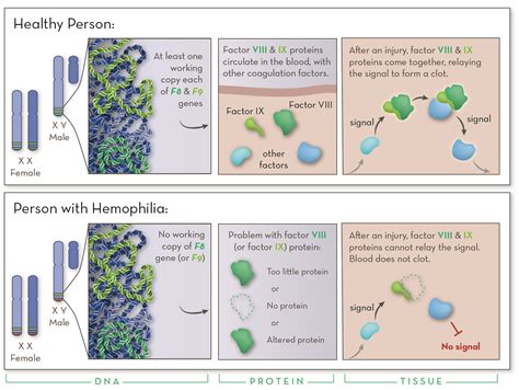 Haemophilia Disease What Is It How Is It Caused What Is Hemophilia?