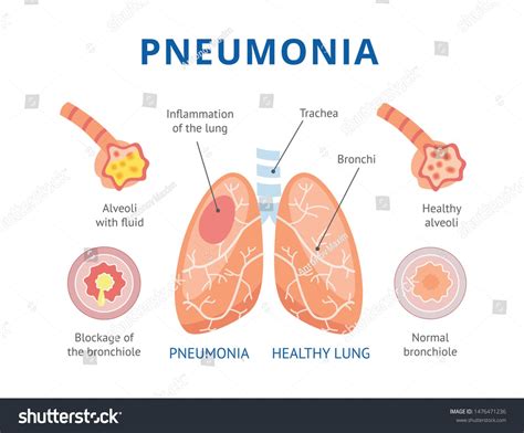 Medical infographics of human pneumonia. The lungs are healthy and ...