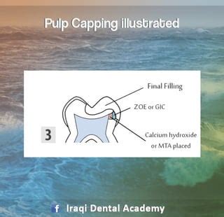Image result for Direct Pulp Capping Vs RCT