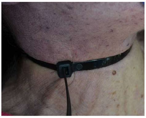 Image result for Famous Cases of Strangulation