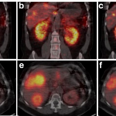 Image result for Normal DaTscan