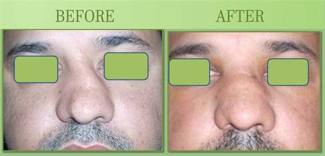 Deviated Nose Care in Surat | Dr. Ashutosh Shah