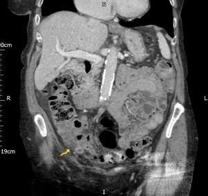 Image result for Normal Appendix Coronal