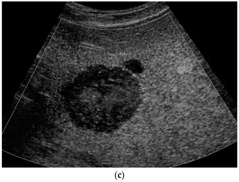 Review on Pediatric Malignant Focal Liver Lesions with Imaging Evaluation: Part II