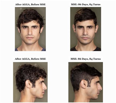Jawhacks mse results - very noticeable increase in midface widening despite already having a ...