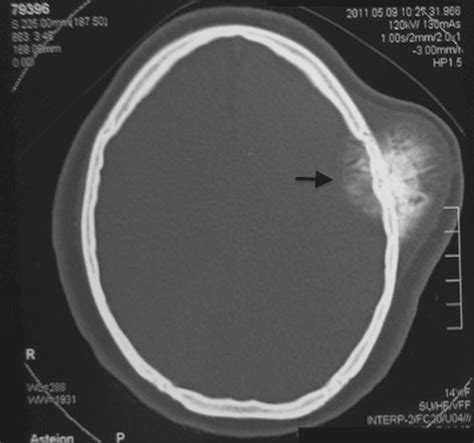 SciELO Brasil - Primary osteosarcoma of the cranial vault Primary osteosarcoma of the cranial vault