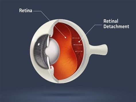 Image result for Visual Problems