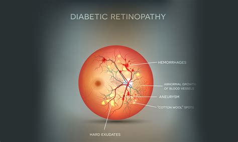 Early treatment with anti-VEGF injections reduces diabetic retinopathy ...