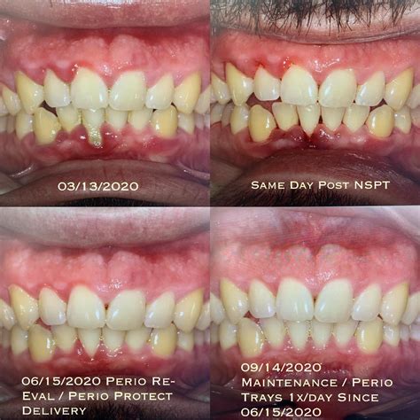 Brittany Simon | ⚡️Perio Protect B & A⚡️ 03/13/2020 New patient diagnostics, initial treatment ...