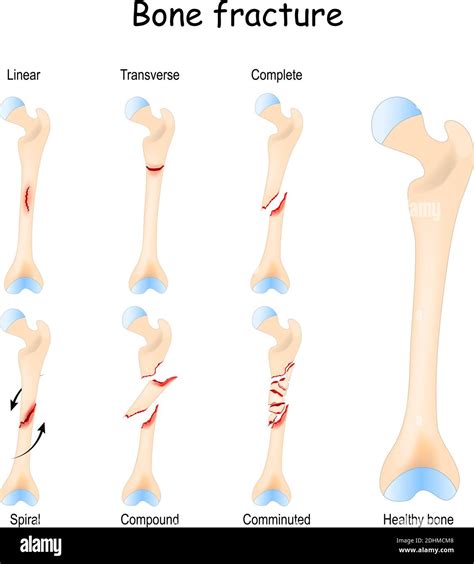 Compound Fracture Diagram