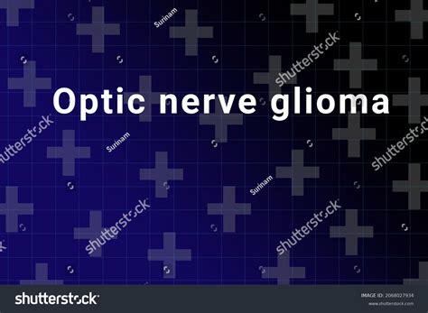 Optic Nerve Glioma Disease Illustration Optic Stock Illustration 2068027934 | Shutterstock