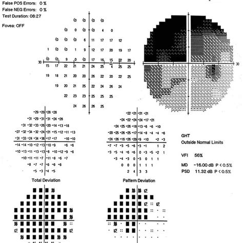 Image result for Abnormal Visual Field Testing