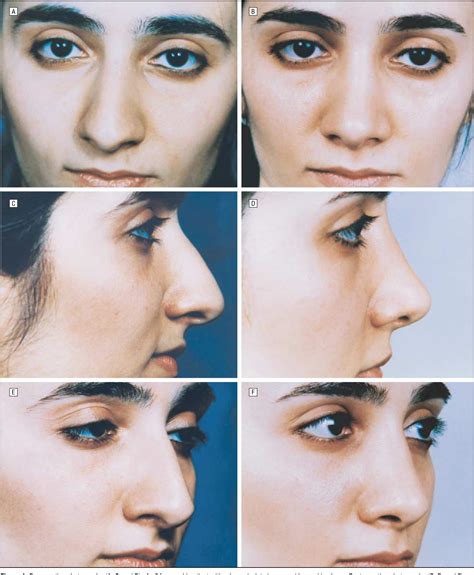 Structure of dorsum of nose | Semantic Scholar