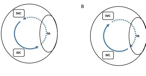 Image result for Atrial Flutter ECG Pattern