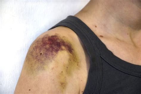 Bruises: Symptoms, Causes, Diagnosis, Treatment, Remedies