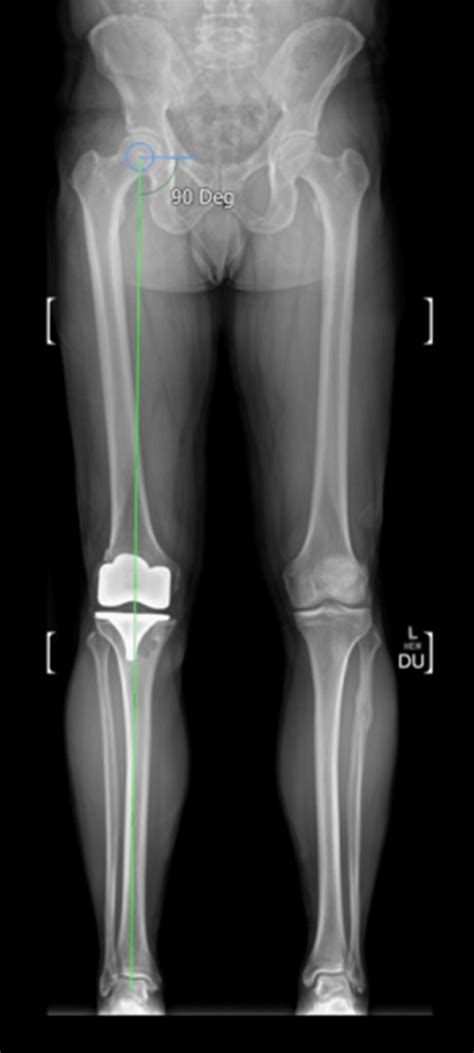 Image result for Leg Alignment