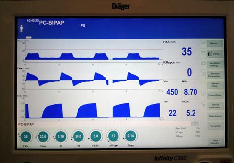 Assist Control Ventilation