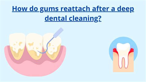 That’s how gums reattach to teeth after deep cleaning