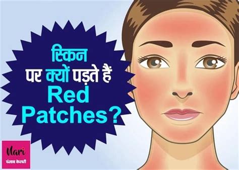 स्किन पर क्यों पड़ते हैं लाल धब्बे, कैसे करें इलाज? - why-do-red-spots ...