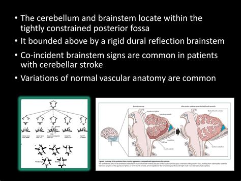 Brief review in cerebellar stroke -diagnosis | PDF | Brain and Nervous System Disorders ...
