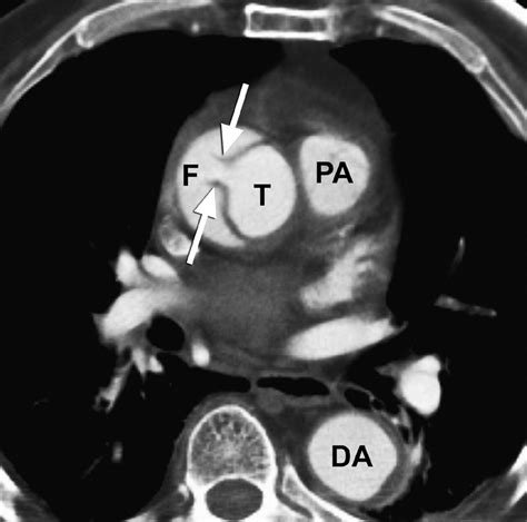 Intimomedial Rupture: A New CT Finding to Distinguish True from False Lumen in Aortic Dissection ...