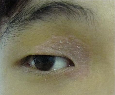以为眼睛上的皮疹是神经性皮炎，看了医生才知道是药物过敏 - 知乎