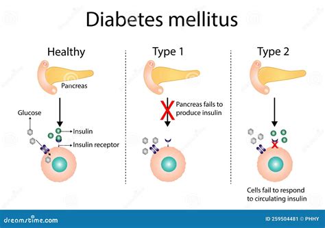 Diabetes Mellitus Type 1, Pancreas S Failure To Produce Enough Insulin ...
