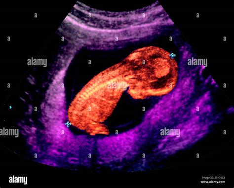 Thirteen week old foetus. Coloured ultrasound scan of a thirteen week ...