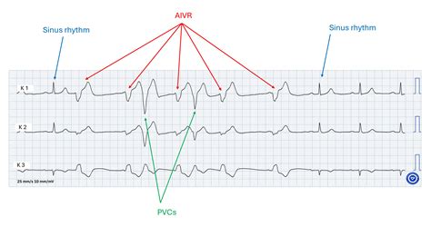 Image result for PVC ECG Reading