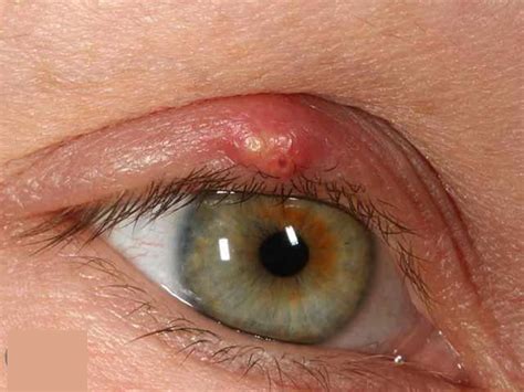 Pimple On Eyelid - Types, Causes & How To Treat Them