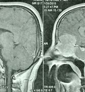 Image result for rhinotomy