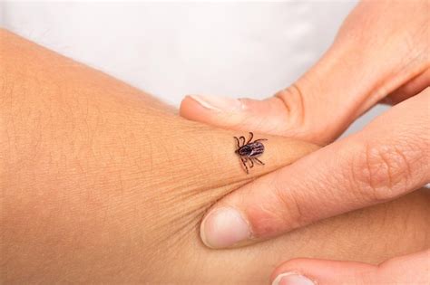 Tick that is biting an arm to a girl | Premium Photo