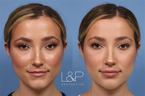 Natural Lip Plump For Gorgeous Twenty-Something
