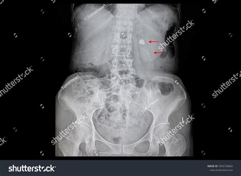 Kidney X Ray Labeled at Mary Benally blog