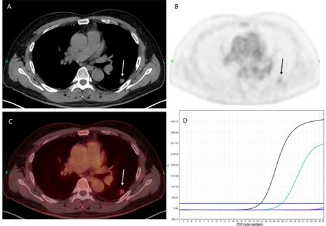 Pet/Ct Imaging In Different Types Of Lung Cancer An Overview at Jacob ...