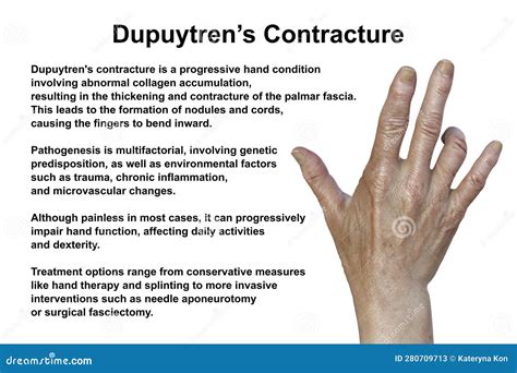 Hand of a Patient with Dupuytren S Contracture, Photorealistic 3D Illustration Stock ...