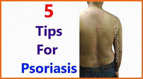 Psoriasis Treatment | Psoriasis Treatment In Homeopathy | Psoriasis ...