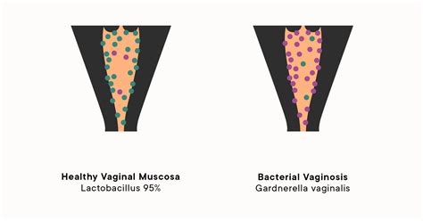 Bacterial Vaginosis and Abnormal Vaginal Discharge: Causes, Symptoms ...