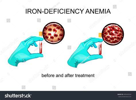 1,448 Iron Deficiency Blood Images, Stock Photos & Vectors | Shutterstock