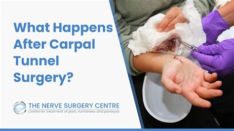 Carpal Tunnel Surgery Recovery Time
