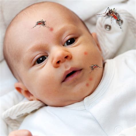 Mosquito Bites On Baby Face
