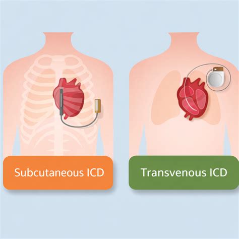 Subcutaneous ICD vs. Transvenous ICD: How I Make the Decision | Dr. M.S ...