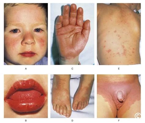 IVIG treatment for acute Kawasaki disease explained