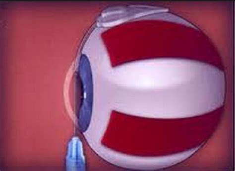 Best Doctor For Glaucoma Treatment In Delhi NCR, Gurgaon