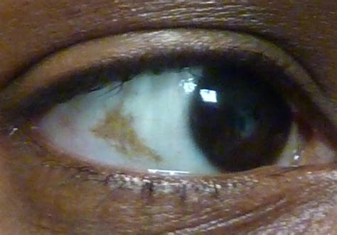 What Are Brown Spots In Your Eyes - Infoupdate.org