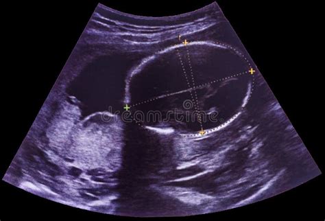 Ultrasound 的图像结果