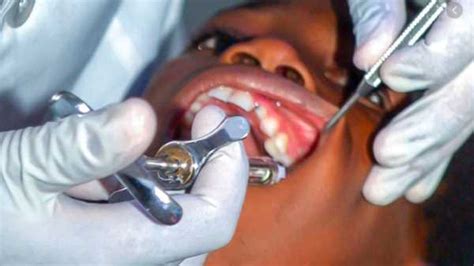 Image result for Tooth Extraction Injection