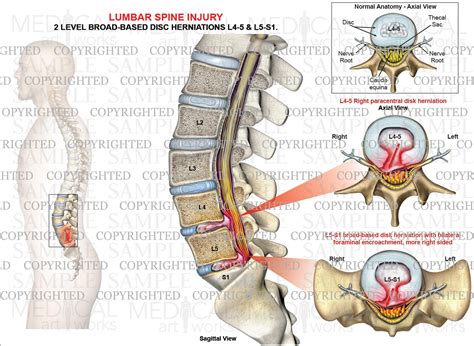 Herniated Disc L4 L5