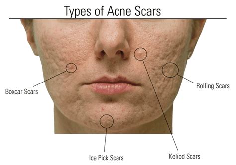 Acne Scars: Types of Acne Scarring and Ideal Treatments