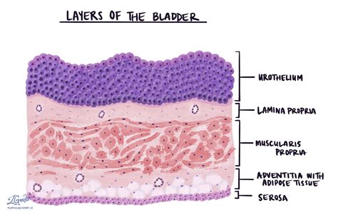 尿路上皮乳頭腫 | MyPathologyReport